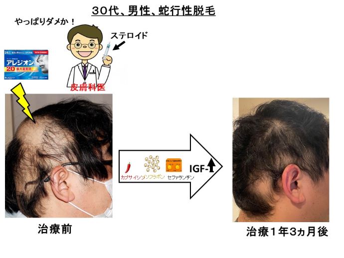 円形脱毛症　病院